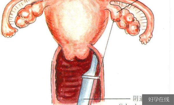 不能阴道取卵的原因