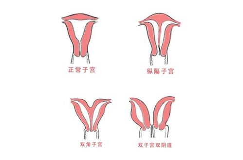 优贝健康UBABE格鲁吉亚ReproArt诊所专家解释女性患有子宫畸形可以做试管婴儿吗？