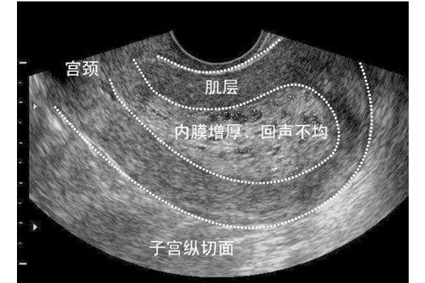 子宫内膜增长的B超呈像