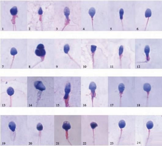 畸形精子是指精子头部、颈部、尾部的形态异常