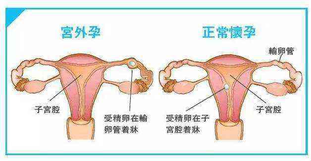 宫外孕与正常怀孕对比图