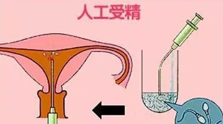 深圳人工授精费用取决于操作次数