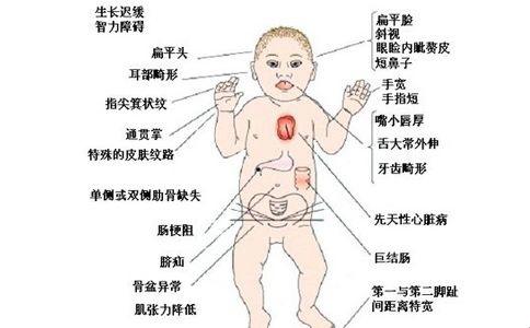 21三体综合征患者