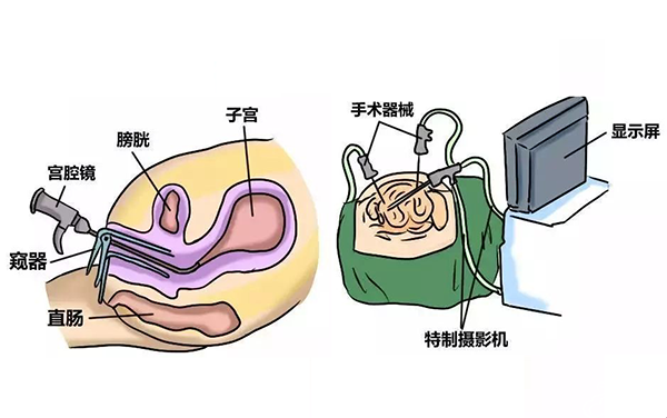 宫腔镜检查的步骤