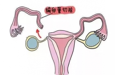 厦门慈铭博鳌国际医院三代试管婴儿，切除双侧输卵管还能做试管婴儿吗？