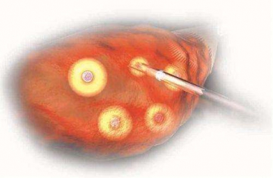 厦门格鲁吉亚Innova医院专家解释促排卵有几种方式？