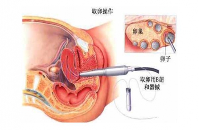 厦门“二孩政策”致浙江试管婴儿激增，但费用和成功率不成正比